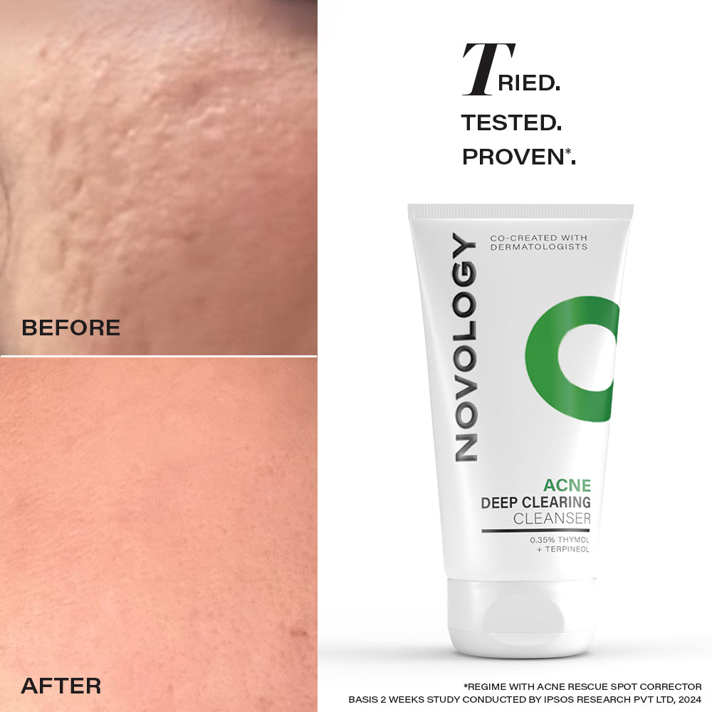 Novology Acne Deep Clearing Cleanser