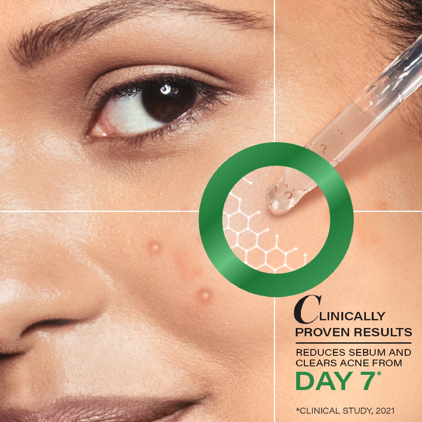Acne Clearing Serum